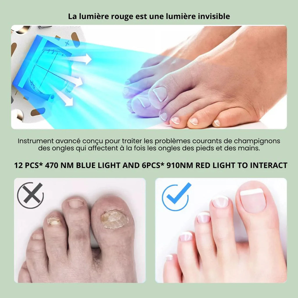 Dispositif de Traitement des Mycoses aux Ongles des Pieds｜CleanMyco™