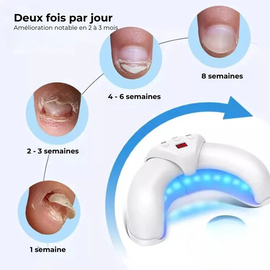 Dispositif de Traitement des Mycoses aux Ongles des Pieds｜CleanMyco™